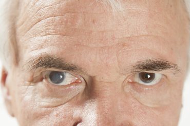 Cataracts Awareness: What You Need to Know