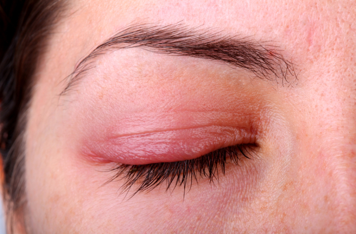 Eye Health Disease Blepharitis