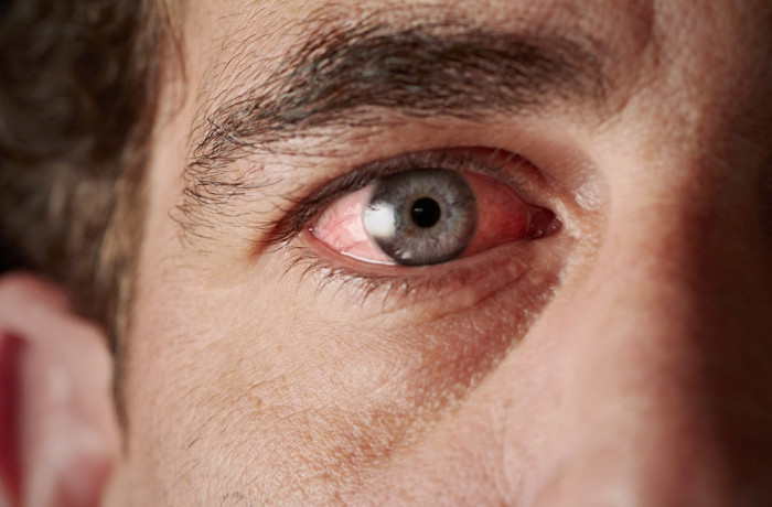 Eye Health Disease Conjunctivitis