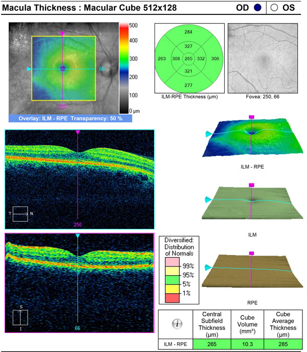 indianapolis eye doctor nora eye care oct report macula thickness macular cube