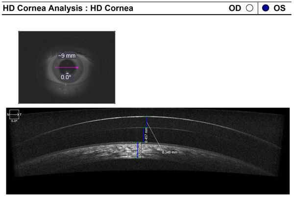 indianapolis eye doctor nora eye care pachymetry