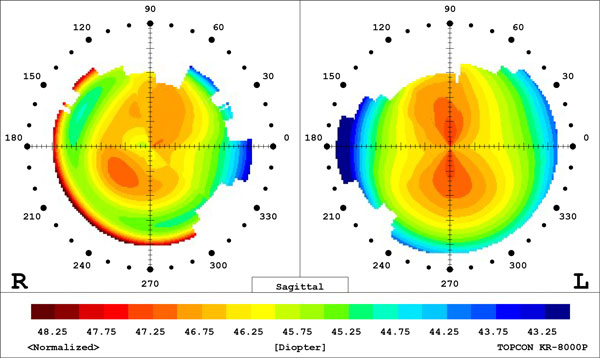 indianapolis eye doctor nora eye care topography